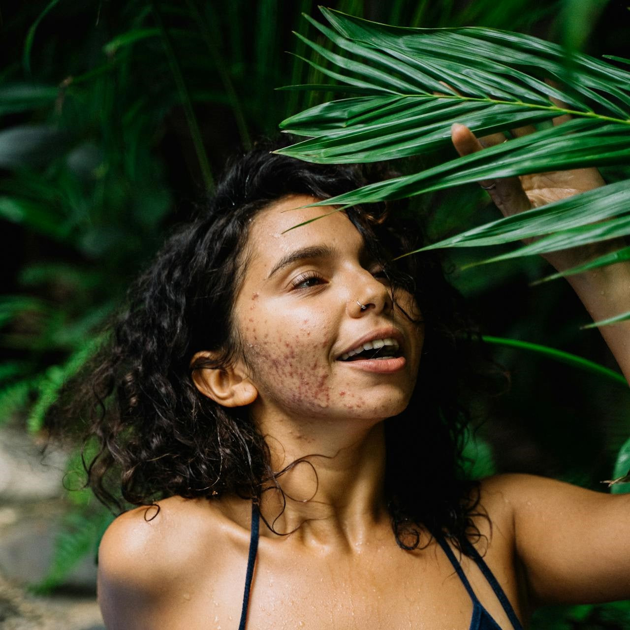 Simple Skincare Routine for Acne-Prone Skin (Natural Approach)